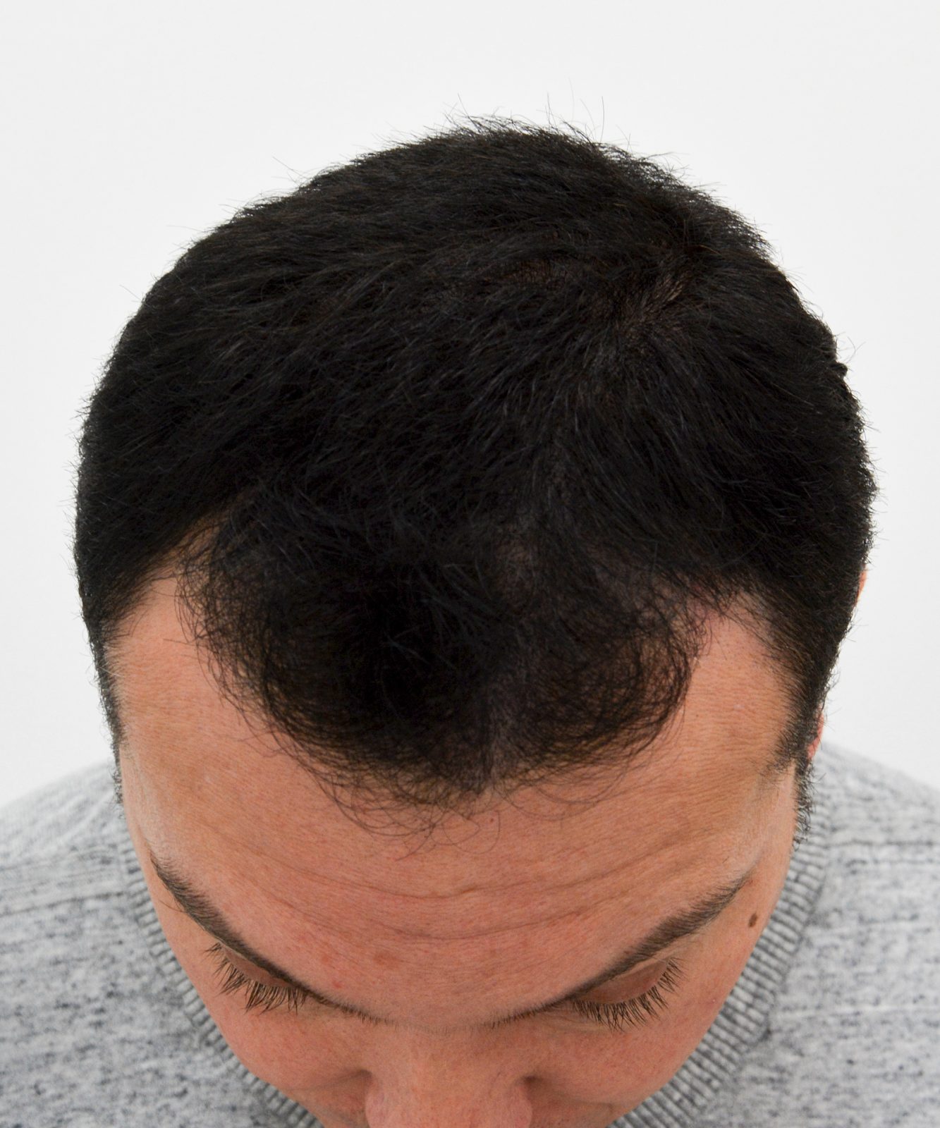 After: Tricopigmentation