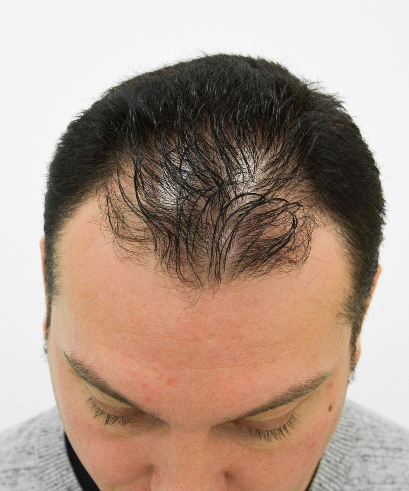 Before: Tricopigmentation