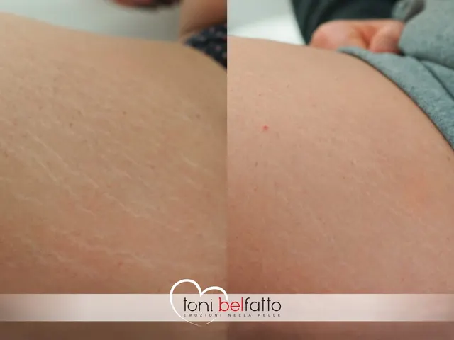 Smagliature camuffate con dermopigmentazione, prima e dopo
