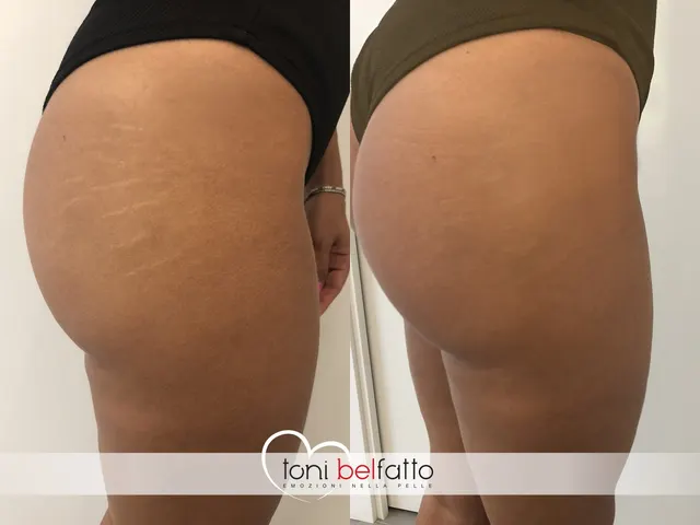 Smagliature camuffate con dermopigmentazione, prima e dopo