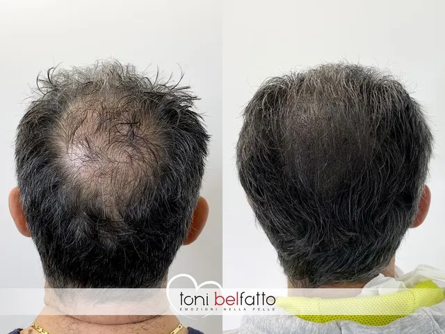 Scalp micropigmentation, before and after