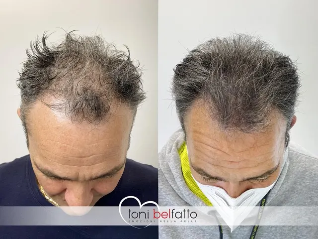 Scalp micropigmentation, before and after