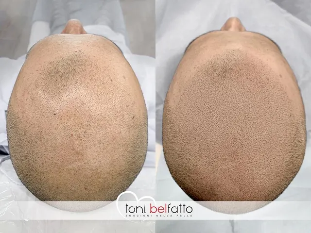 Scalp micropigmentation, before and after