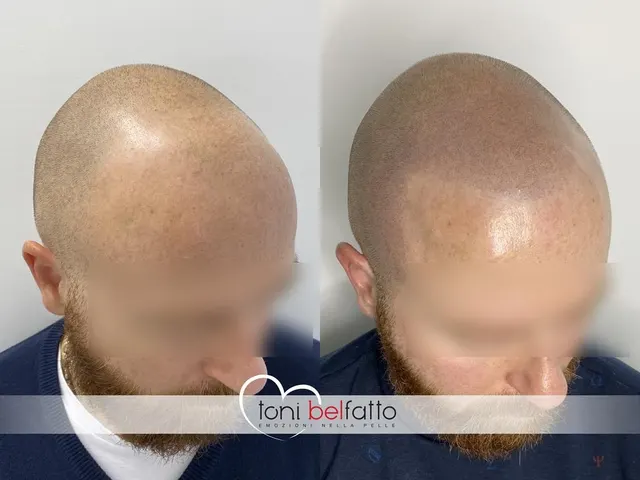 Scalp micropigmentation, before and after