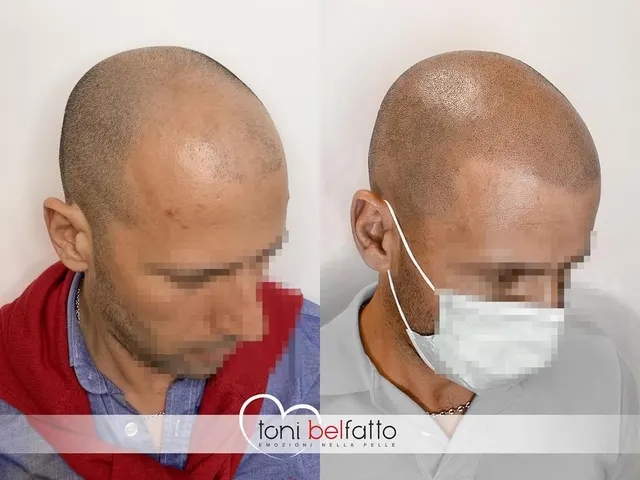 Scalp micropigmentation, before and after
