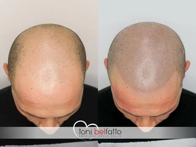 Scalp micropigmentation, before and after