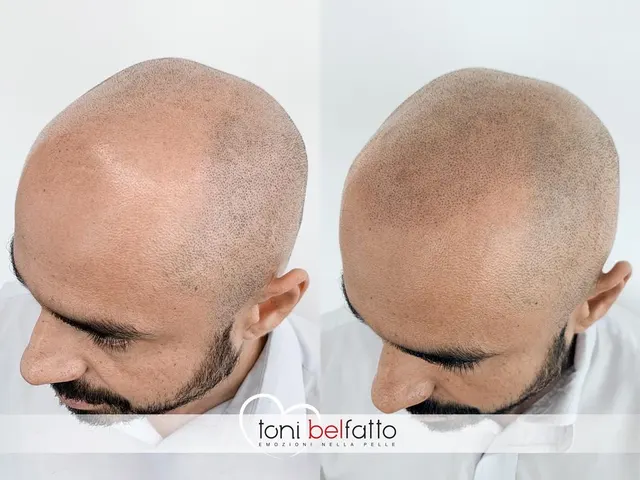 Scalp micropigmentation, before and after