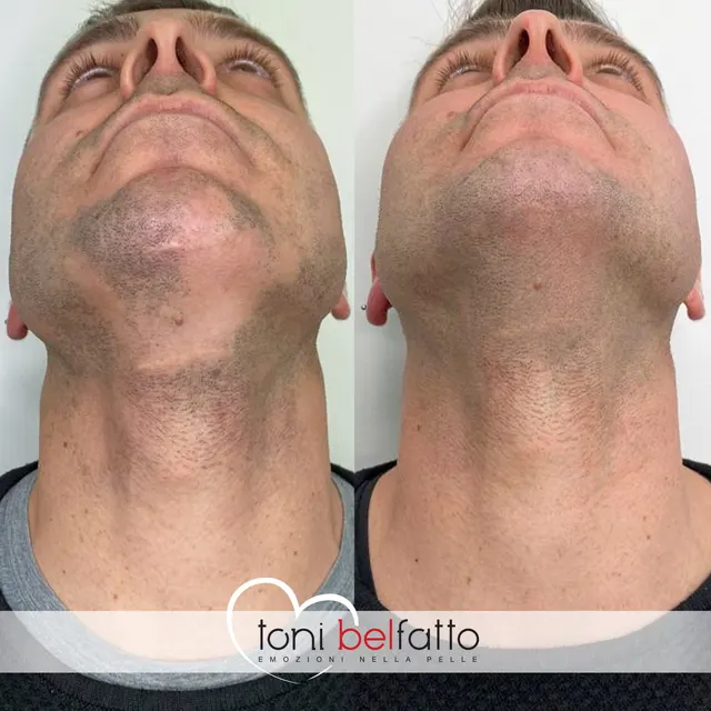 Beard micropigmentation, before and after
