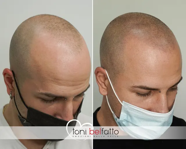 Scalp micropigmentation, before and after