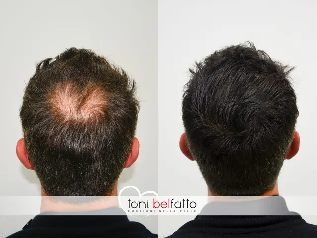Scalp micropigmentation, before and after