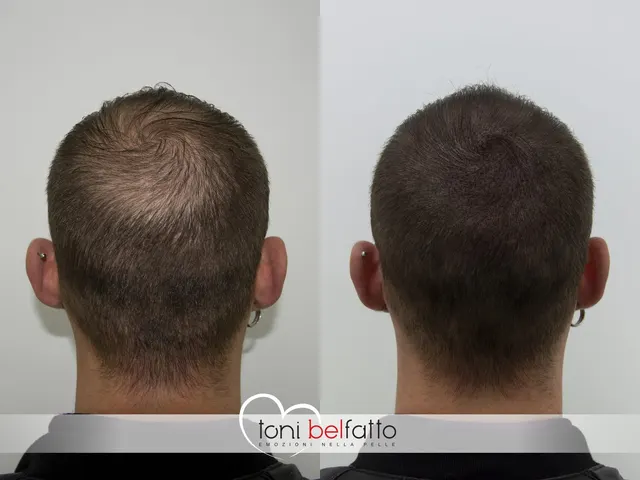 Scalp micropigmentation, before and after