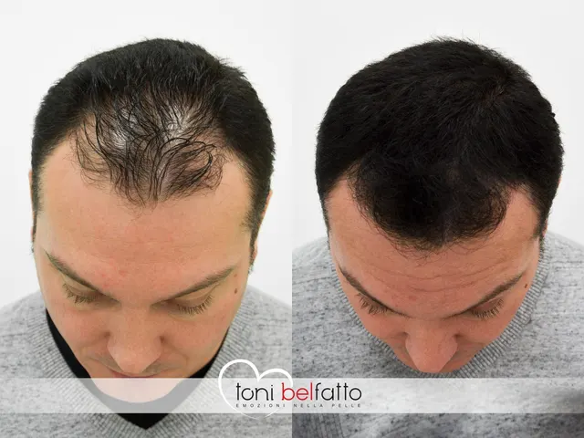 Scalp micropigmentation, before and after