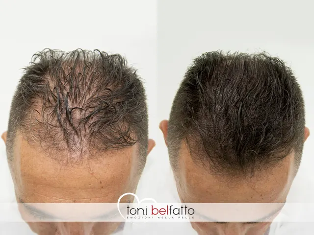 Scalp micropigmentation, before and after