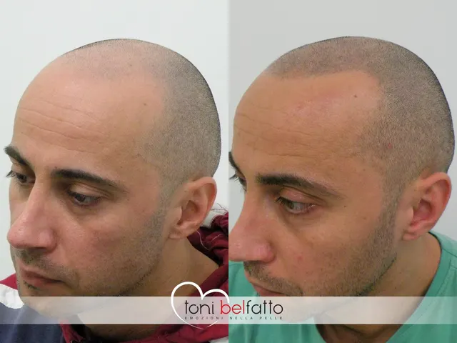 Scalp micropigmentation, before and after
