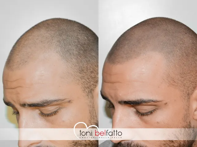 Scalp micropigmentation over a transplant scar, before and after