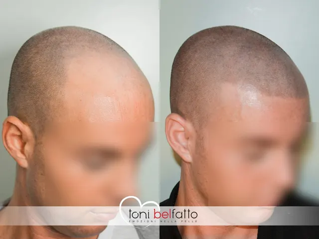 Scalp micropigmentation, before and after