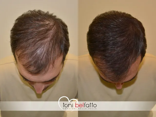 Scalp micropigmentation, before and after