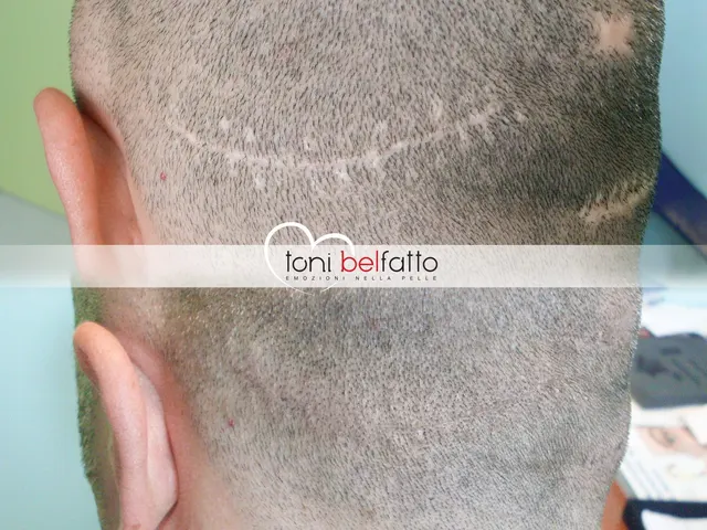 Scalp micropigmentation, before and after