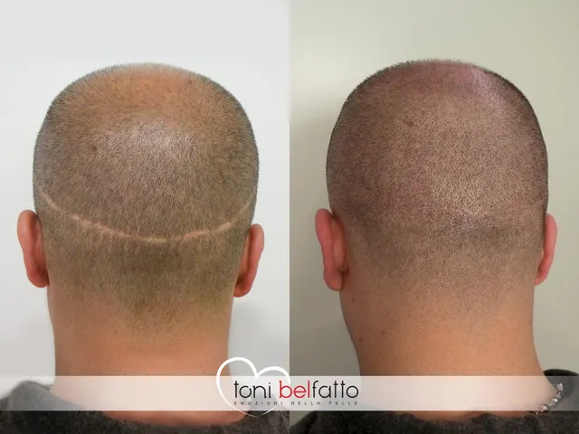 Scalp micropigmentation, before and after