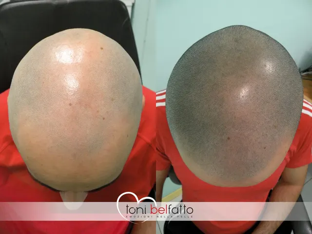 Scalp micropigmentation, before and after