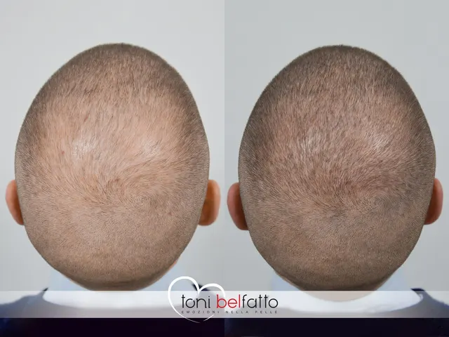 Scalp micropigmentation, before and after