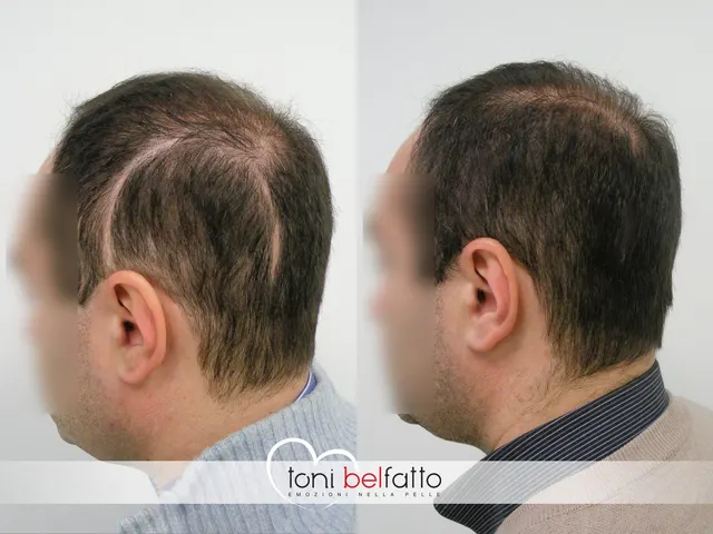 Scalp micropigmentation, before and after