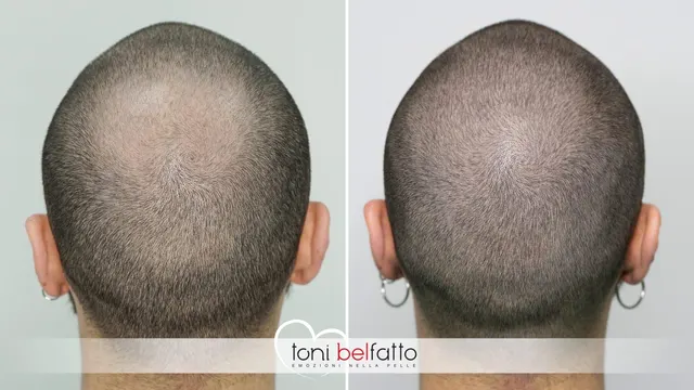 Scalp micropigmentation, before and after