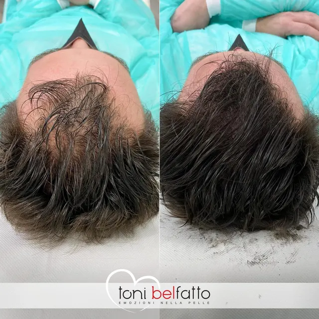 Scalp micropigmentation, before and after