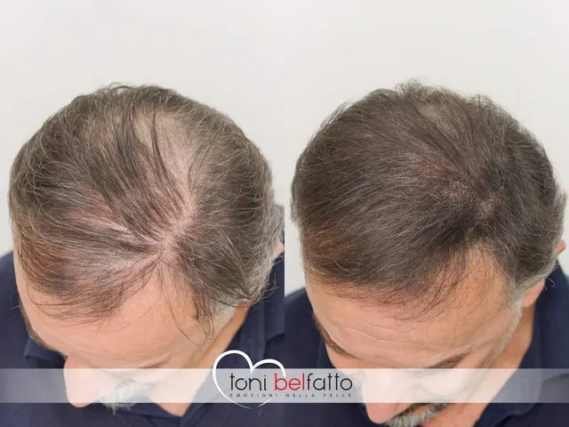 Scalp micropigmentation, before and after