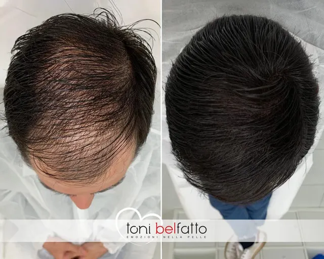 Scalp micropigmentation, before and after