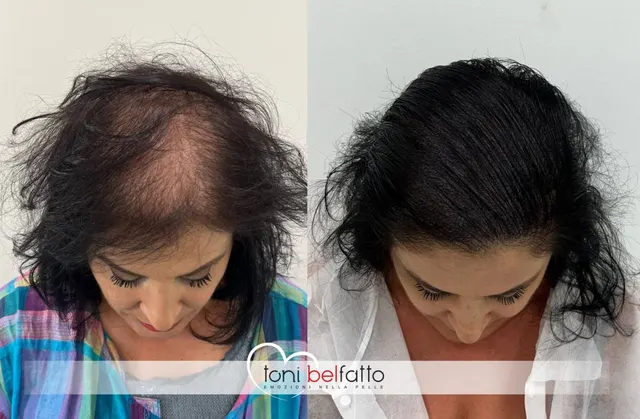 Scalp micropigmentation, before and after