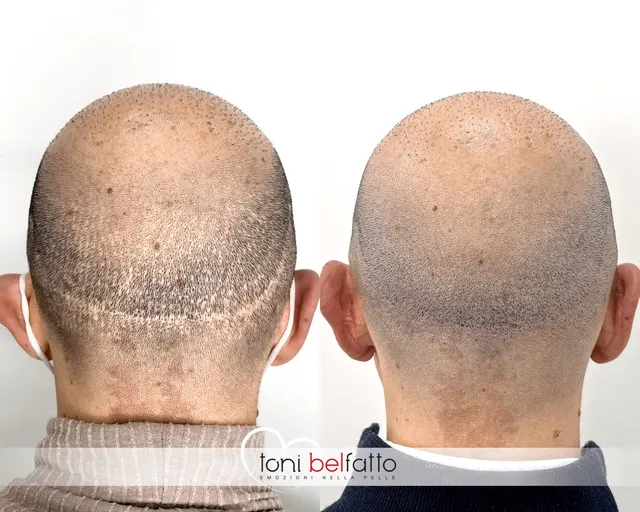 Scalp micropigmentation over FUT and FUE transplant scars, before and after