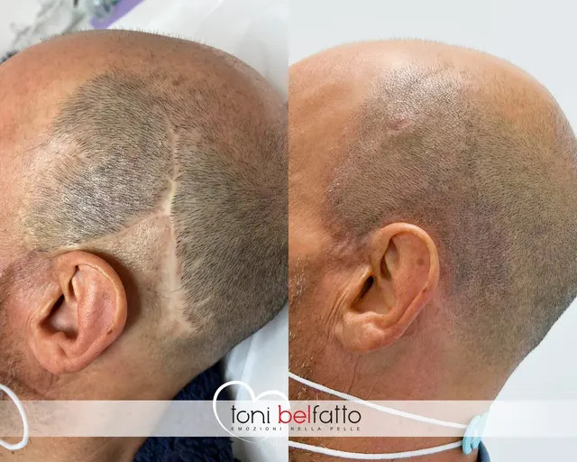 Scalp micropigmentation, before and after
