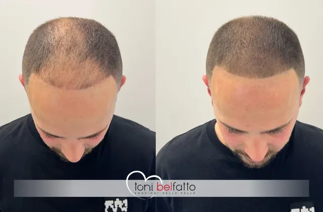 Scalp micropigmentation, before and after